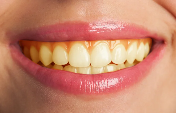 teeth whitening abu dhabi