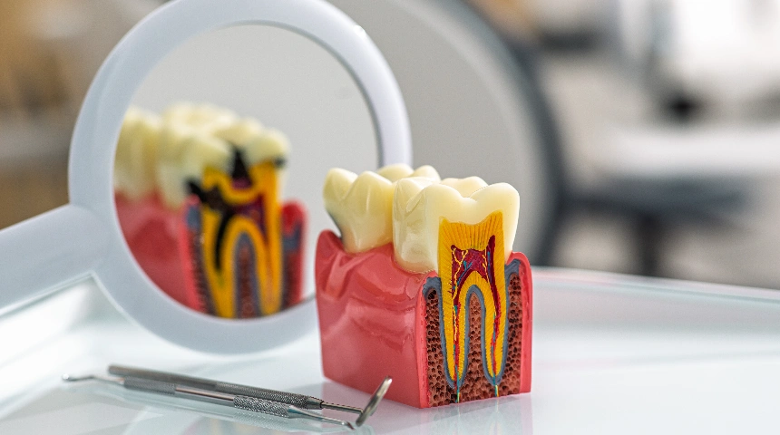 Root Canal Treatment